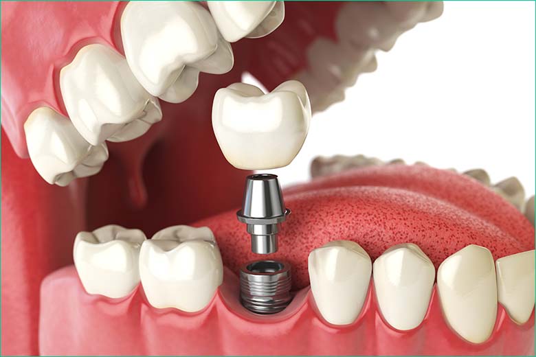 dental implant toronto dentist west village dental clinic