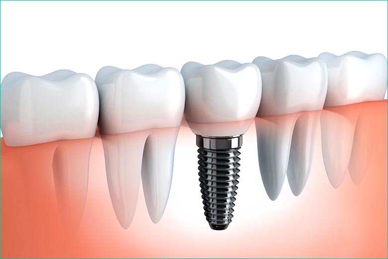 dental implants in toronto - west village dental - dr. triassi