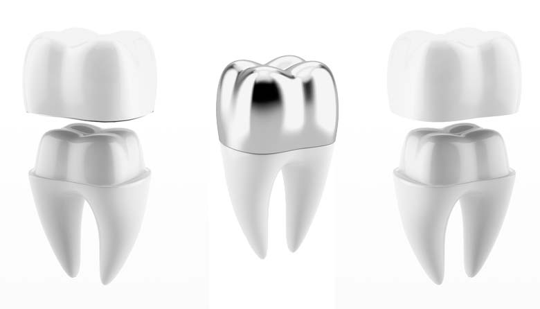 porcelain dental crown, metal dental crown, porcelain fused to metal dental crown