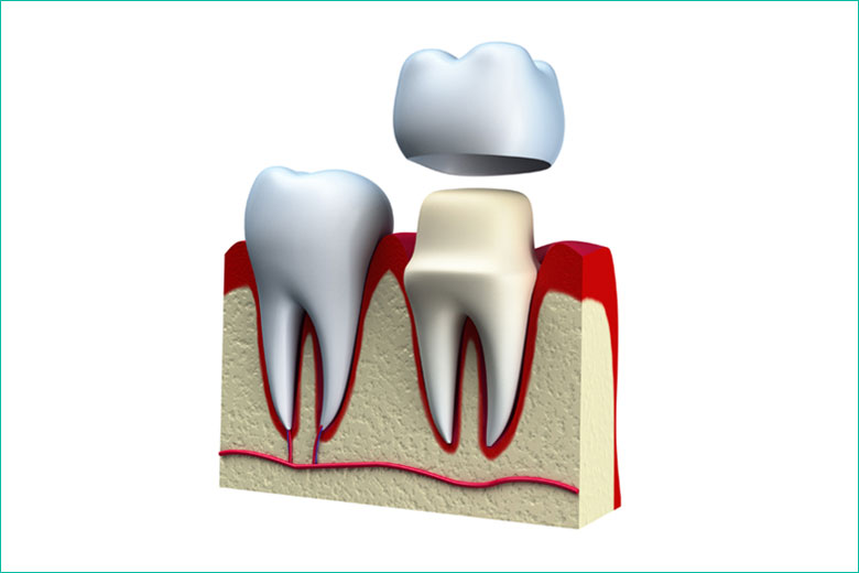 dental crown and dental cap in toronto dentist west village dental clinic - dr. triassi